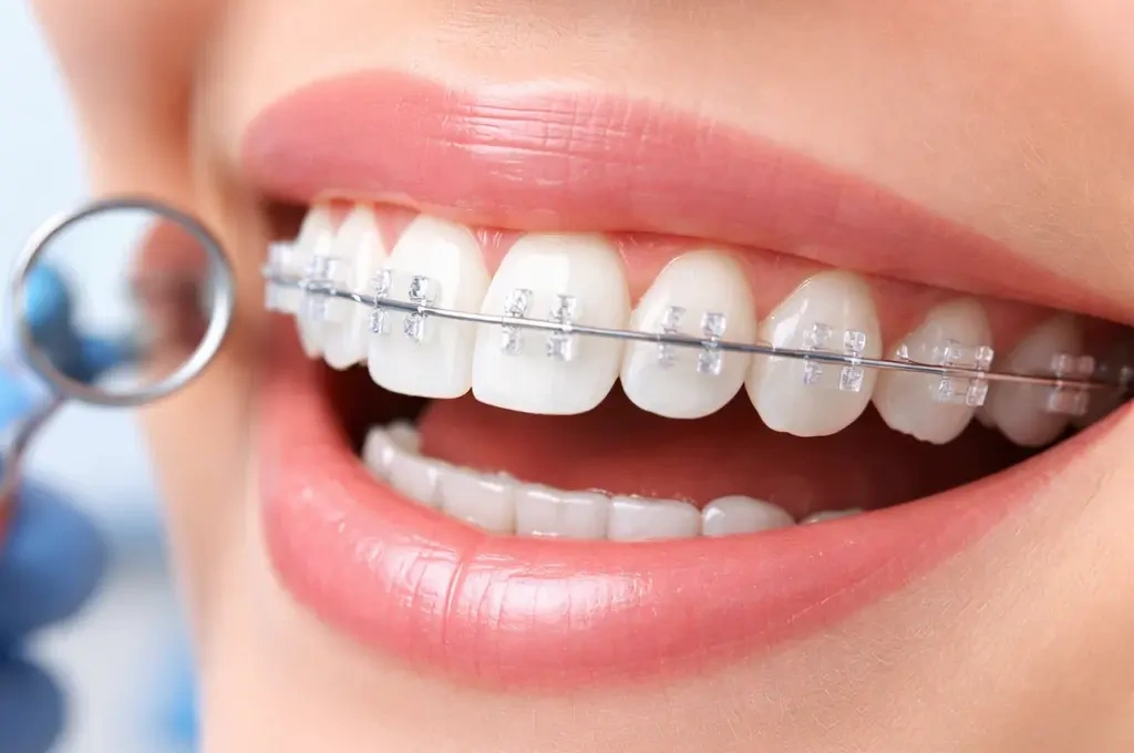 ortodoncia-alineadores-invicibles